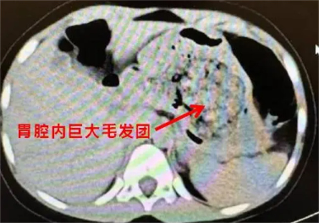 浙江一5岁女孩确诊长发公主综合征 何为长发公主症