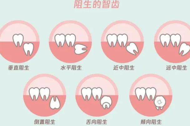 智齿到底应不应该拔掉：无问题可不拔(阻生智齿需拔)