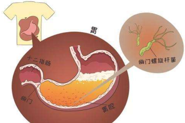 什么是幽门螺旋杆菌：能在胃中生存的细菌(引发胃炎等)