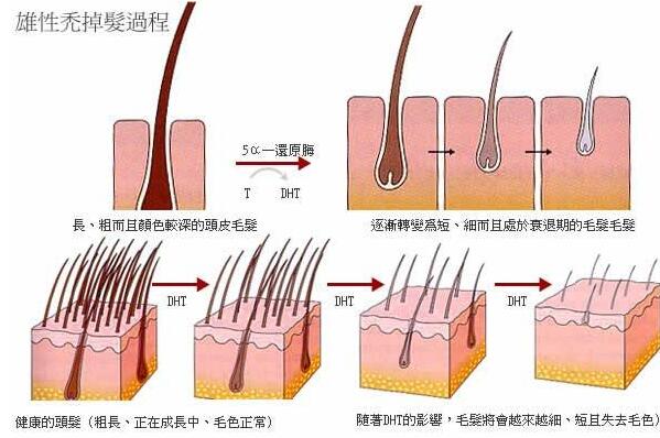 脱发是什么原因引起的?与遗传因素有关，预兆身体有疾病