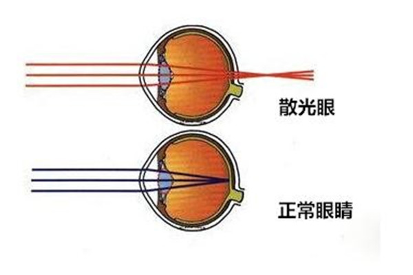 散光是怎么造成的 人为什么会发生散光