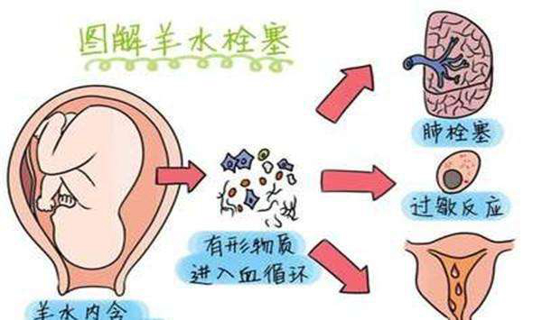 羊水栓塞是什么?羊水栓塞主要原因是什么(80%死亡率)